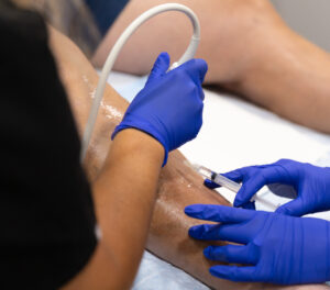 A close-up photo of gloved hands performing a varicose vein treatment near Longboat Key.