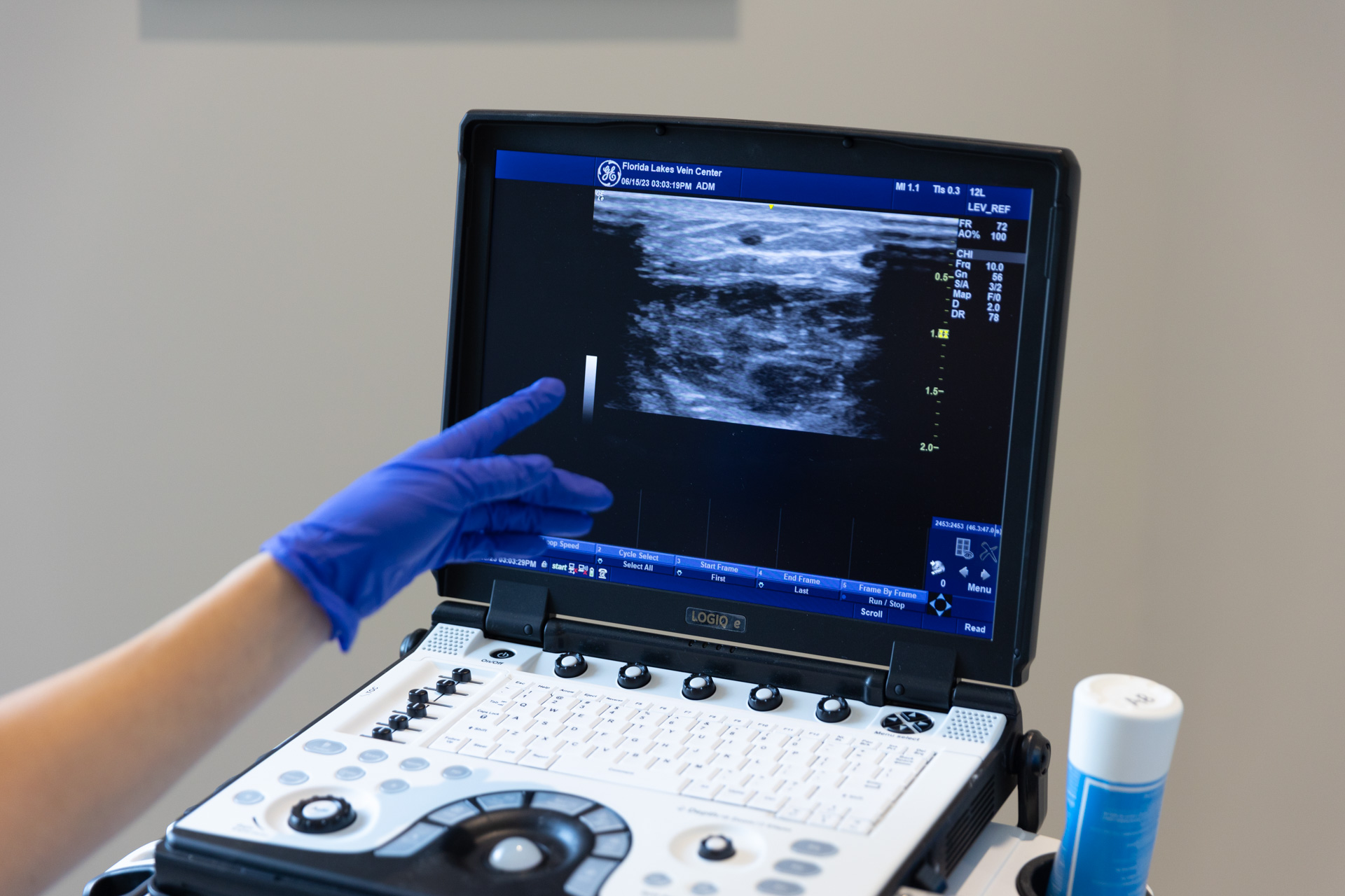 Close-up of a provider using ultrasound technology before nonsurgical vein treatments in Fort Myers.