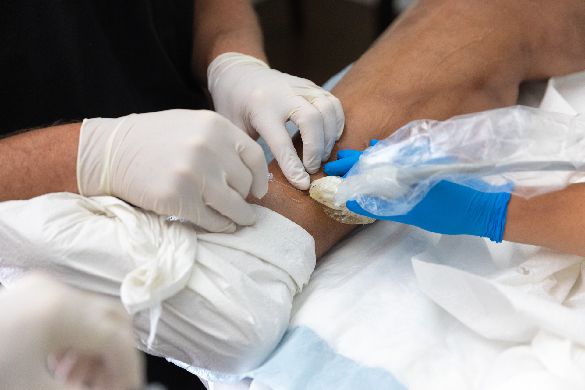 Close-up of a specialist performing a treatment to address a patient's vein pain in Fort Myers.