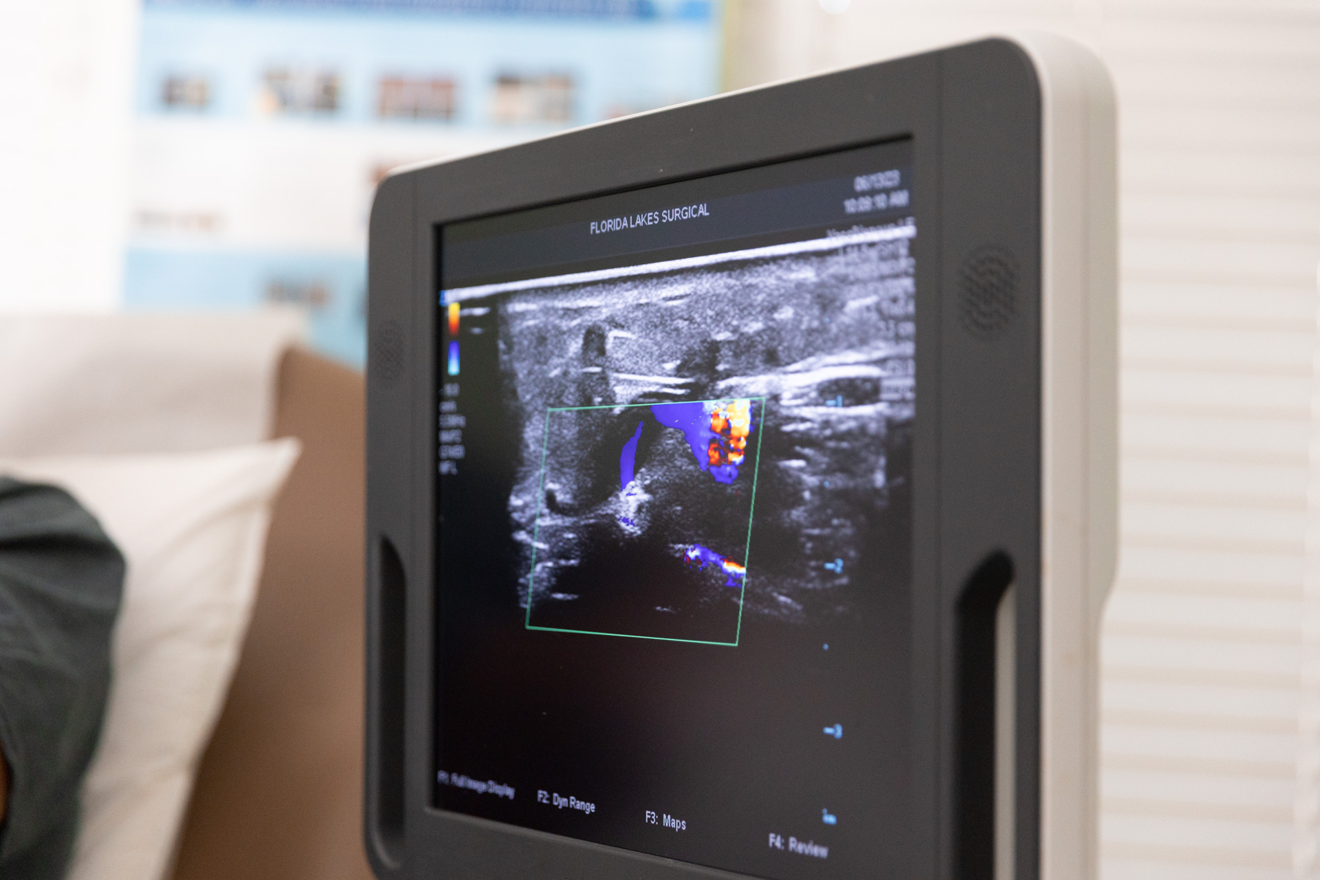 Close-up of an ultrasound screen, used during preventative vein care in Fort Myers at Florida Lakes Vein Center.