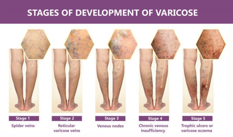 Graphic showing the 5 stages of varicose development leading to varicose vein treatment in Sarasota