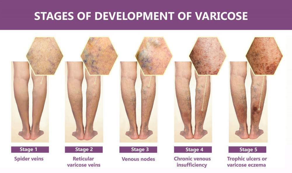 Graphic showing the 5 stages of varicose development leading to varicose vein treatment in Sarasota