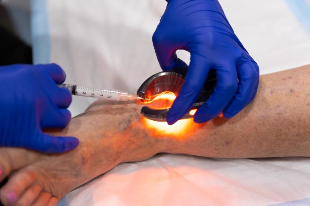 Two hands in medical gloves performing sclerotherapy for a spider vein treatment in Sarasota