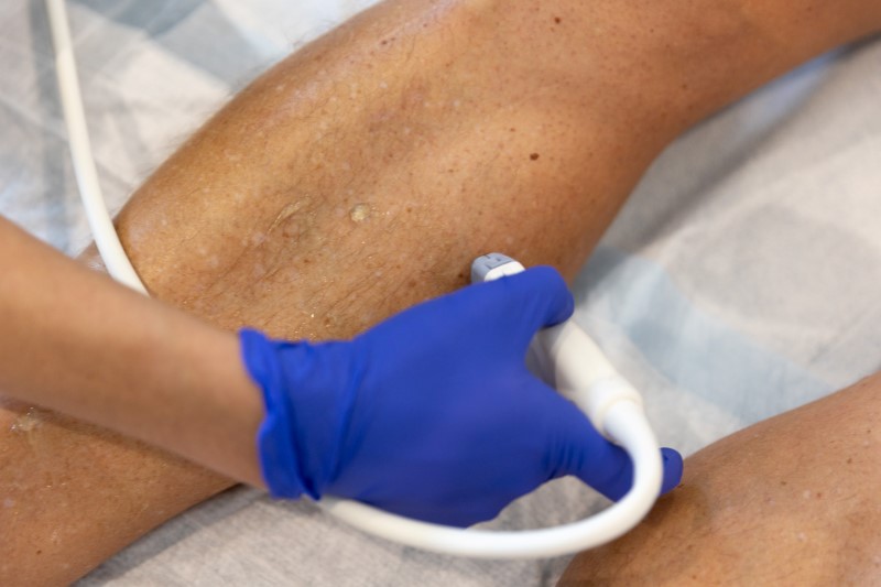 Closeup of a man's leg as he undergoes a leg screening before varicose vein treatment in Sarasota