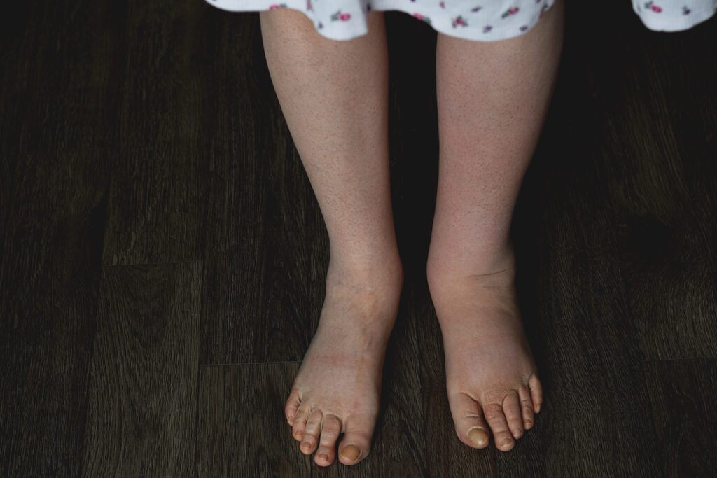 Closeup of woman's ankles and calves, one of which is swollen and in need of lymphedema treatment in Sarasota