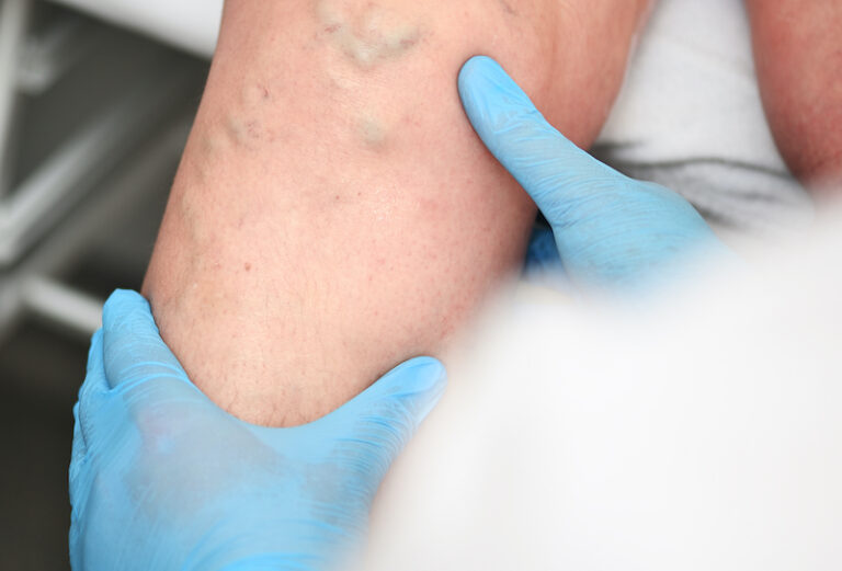 Closeup of a provider's hands holding a patients legs exhibiting varicose veins, as a possible candidate for DVT treatment in Sarasota