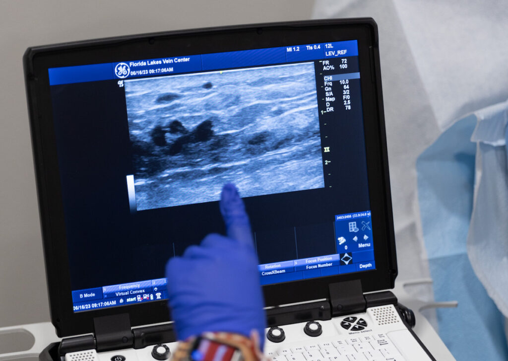 A provider points their finger at a screen which shows an ultrasound image of a vein. The provider examines the vein to determine if a patient requires deep vein thrombosis treatment near Sarasota.