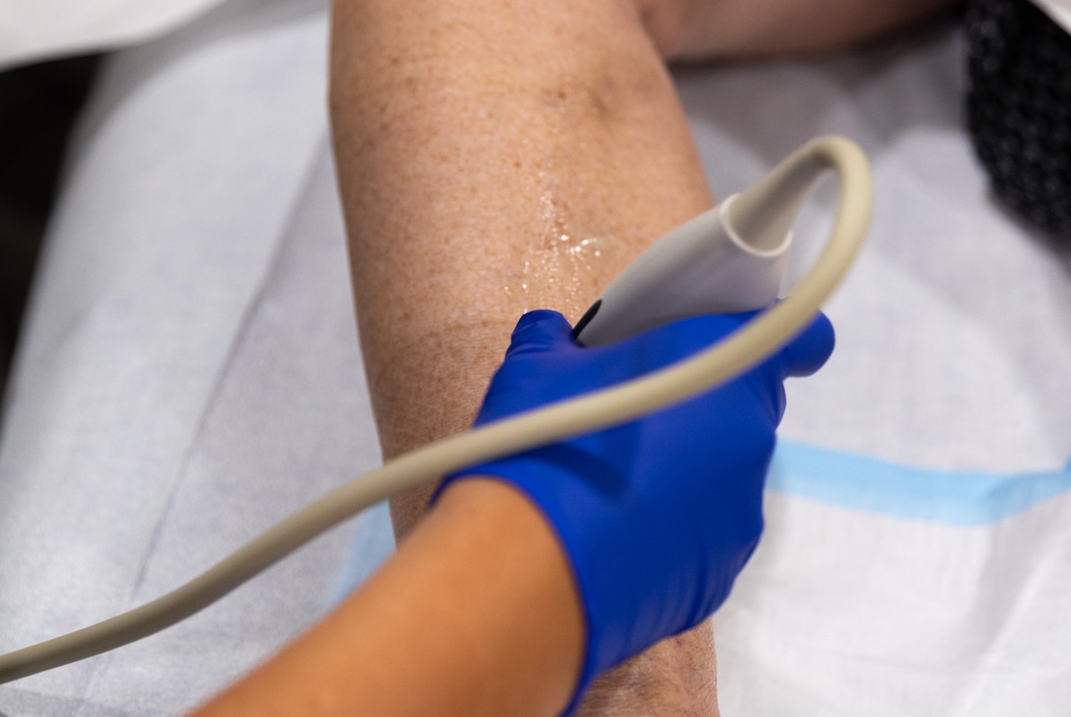 Close-up of a vein specialists using ultrasound technology to assess swollen veins in Fort Myers.